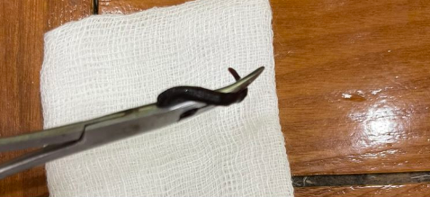 Con vắt còn sống được gắp ra khỏi mũi bé gái. Ảnh: BVCC