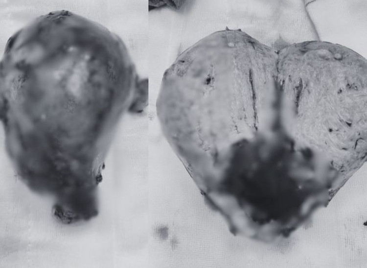 2 khối u xơ tử cung sau khi lấy ra. Ảnh BVCC