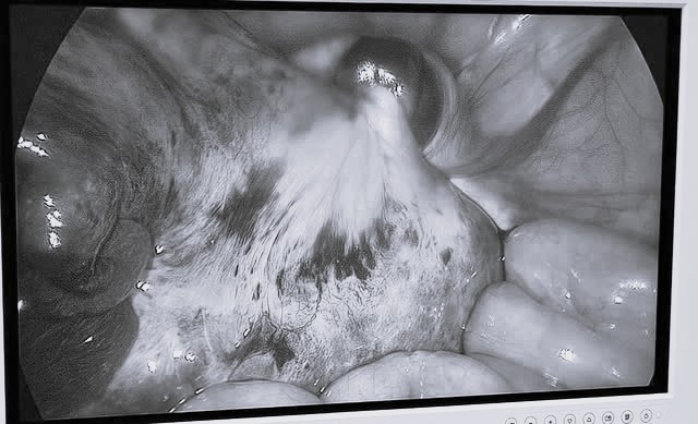 Hình ảnh khối u buồng trứng xoắn của bệnh nhi. Ảnh BVCC