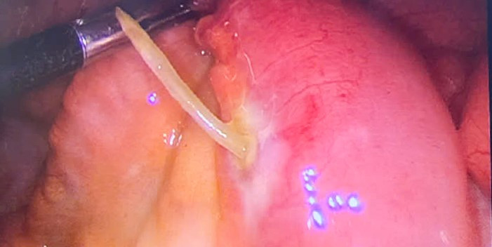 Xương cá xuyên thủng thành ruột non cụ bà 61 tuổi - Ảnh TTYT huyện Thanh Thủy