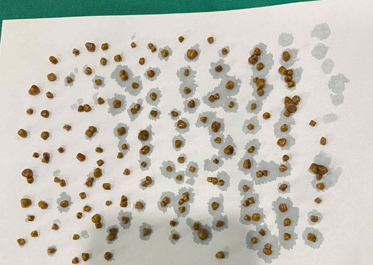 Sỏi túi mật của người bệnh - Ảnh: TTYT huyện Thanh Thủy (Phú Thọ)