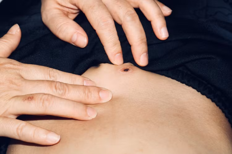 Vết loét trên da bệnh nhi. Ảnh TTYT thị xã Quảng Yên