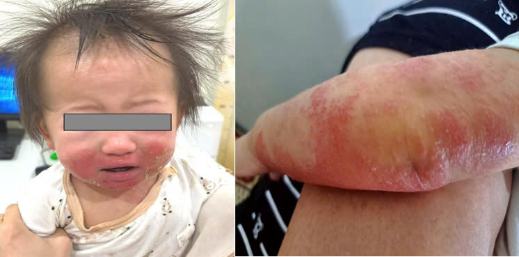 Trẻ bị viêm da cơ địa. Ảnh Bệnh viện Trẻ em Hải Phòng