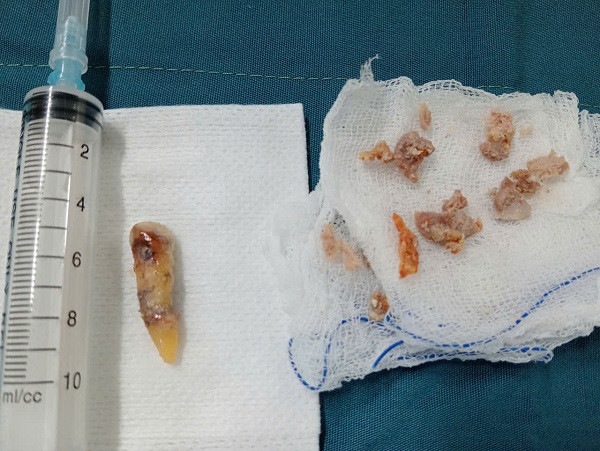 Dị vật được gắp từ thực quản của bệnh nhân. Ảnh BVCC