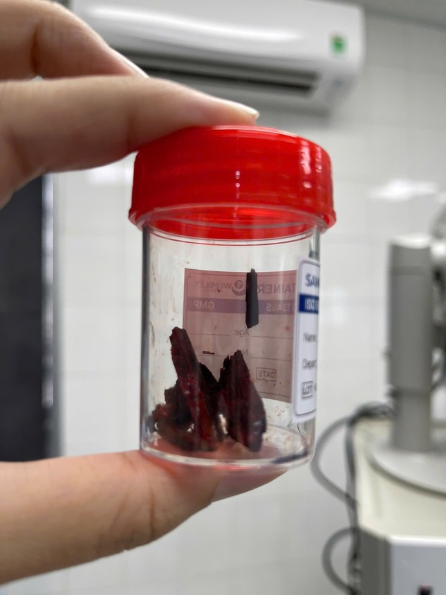 Dị vật là mảnh gỗ được các bác sĩ phẫu thuật lấy ra khỏi hốc mắt bệnh nhân.