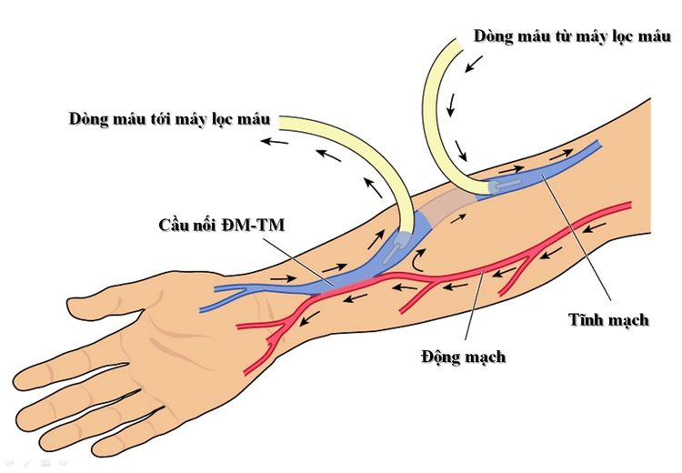 Phẫu thuật đường vào mạch máu chuẩn bị chạy thận nhân tạo