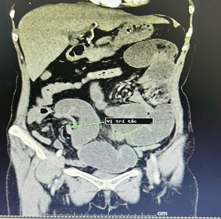 Hình ảnh chụp cắt lớp vi tính cho thấy quai ruột tắc, giãn to khi vào viện. Ảnh BVCC