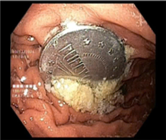 Dị vật đồng xu đường kính 4cm nằm trong dạ dày bệnh nhi. Ảnh BVCC