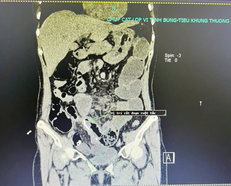 Hình ảnh chụp cắt lớp vi tính sau khi phẫu thuật của người bệnh, tình trạng tắc ruột đã cải thiện rõ rệt. Ảnh BVCC