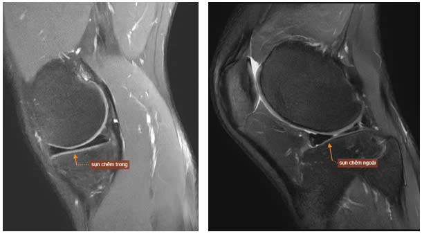 Hình ảnh MRI khớp gối phải của bệnh nhân T.M.H cho thấy dấu hiệu rách quai xô. Ảnh BVCC