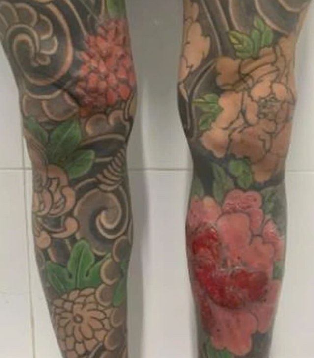 Bệnh nhân xuất hiện triệu chứng ngứa rát vùng mực xăm đỏ. Ảnh Sức khoẻ và Đời sống