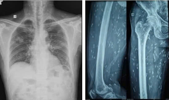 Sán xuất hiện khắp cơ thể người bệnh. Ảnh: BVCC.