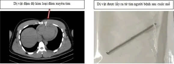 Phim chụp và dị vật được lấy ra ngoài thành công. Ảnh: BVCC