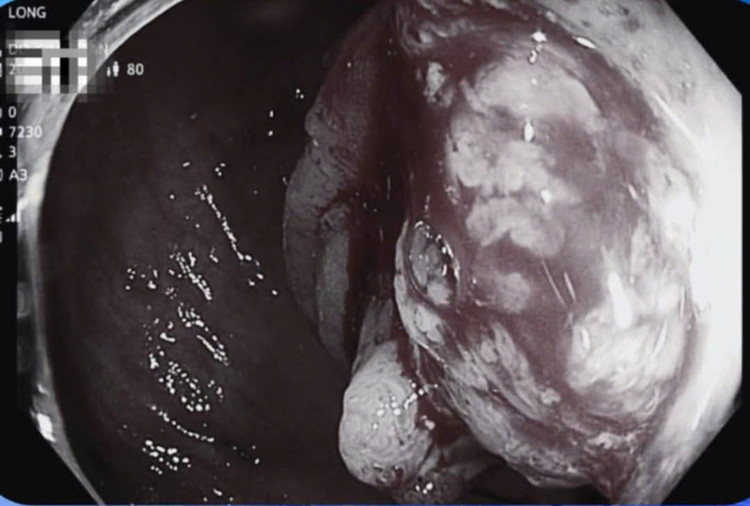 Hình ảnh chụp cắt lớp vi tính đại tràng của bệnh nhân. Ảnh BVCC