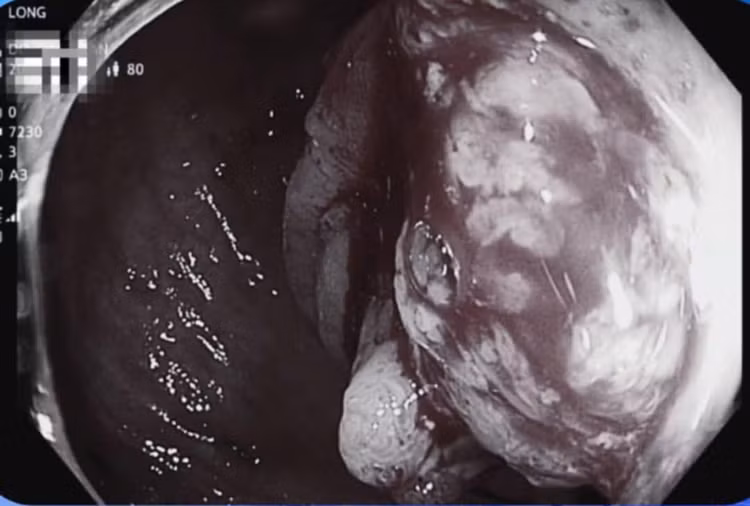 Hình ảnh chụp cắt lớp vi tính đại tràng của bệnh nhân. Ảnh BVCC