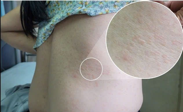 Bệnh nhân bị sẩn ngứa kết quả xét nghiệm dương tính giun đũa chó mèo IgG (1,037 OD). Ảnh Trung tâm Y tế huyện Cẩm Khê