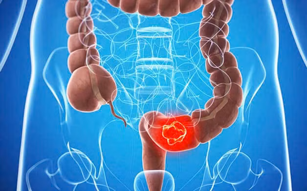 Đại tràng sigma là một phần của ruột già, nằm ở vị trí gần với hậu môn và trực tràng. Ảnh BVCC