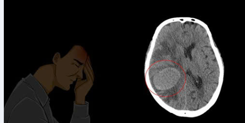 Ung thư phổi có thể di căn đến não, khiến người bệnh có triệu chứng đau đầu, liệt nửa người. Ảnh BVCC