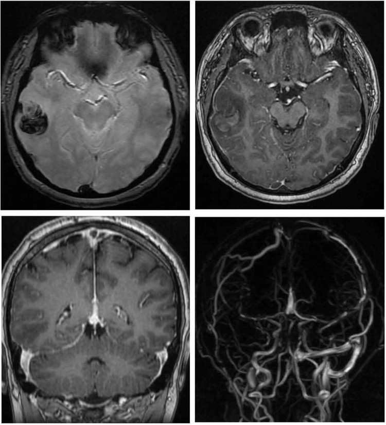 Hình ảnh não của nam thanh niên 22 tuổi bị đột quỵ xuất huyết não do hút shisha liên tục trong một năm qua