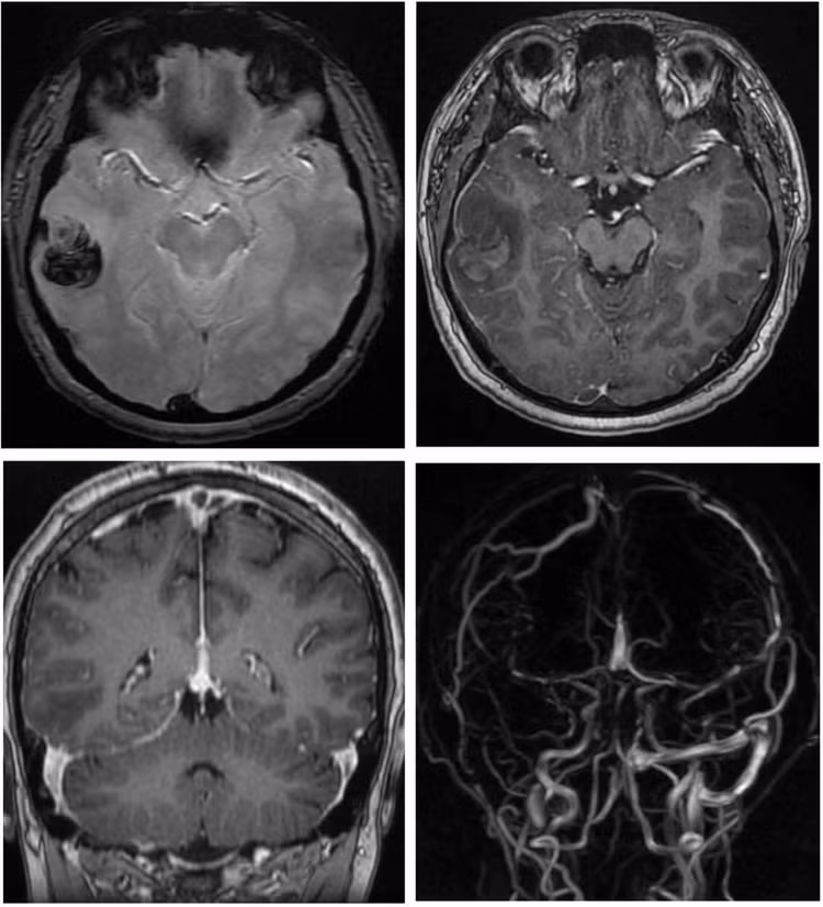 Hình ảnh não của nam thanh niên 22 tuổi bị đột quỵ xuất huyết não do hút shisha liên tục trong một năm qua Hình ảnh não của nam thanh niên 22 tuổi bị đột quỵ xuất huyết não do hút shisha liên tục trong một năm qua