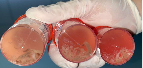 “Dị vật” màu trắng xám (giun lươn) từ dịch rửa phế quản phổi người bệnh. Ảnh BVCC