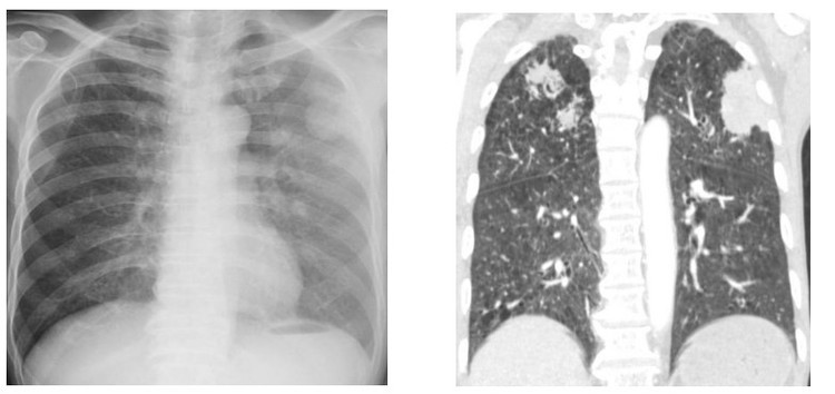 Tổn thương phổi hoại tử hai bên của người bệnh. Ảnh BVCC