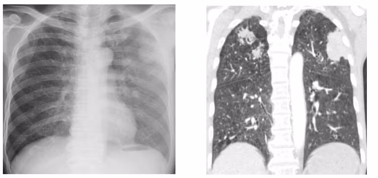 Tổn thương phổi hoại tử hai bên của người bệnh. Ảnh BVCC