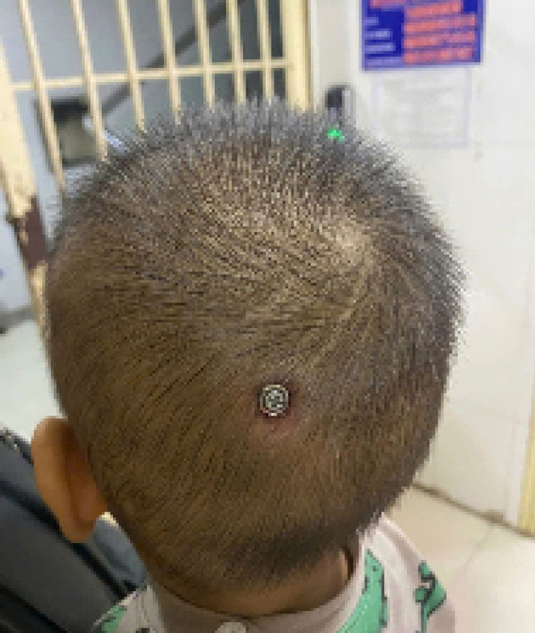 Hình ảnh chụp chiếc đinh đâm vào đầu bệnh nhi. Ảnh BVCC