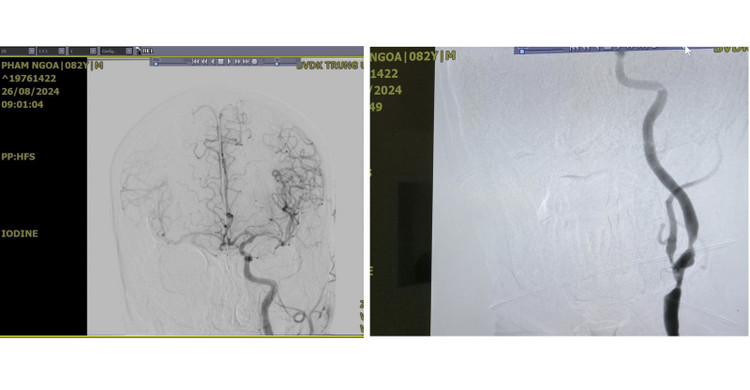 Hình ảnh chụp DSA trước phẫu thuật của người bệnh cho thấy hai bán cầu đại não được cung cấp chỉ duy nhất 1 động mạch cảnh trái đang bị hẹp nặng - Ảnh: BVCC