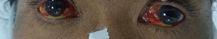 Tình trạng xuất huyết kết mạc kèm vàng mắt đặc trưng của nhiễm Leptospira. Ảnh BVCC
