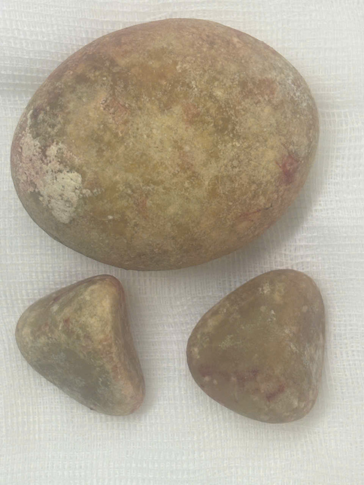 Viên sỏi trong bàng quang của ông D. Ảnh BVCC