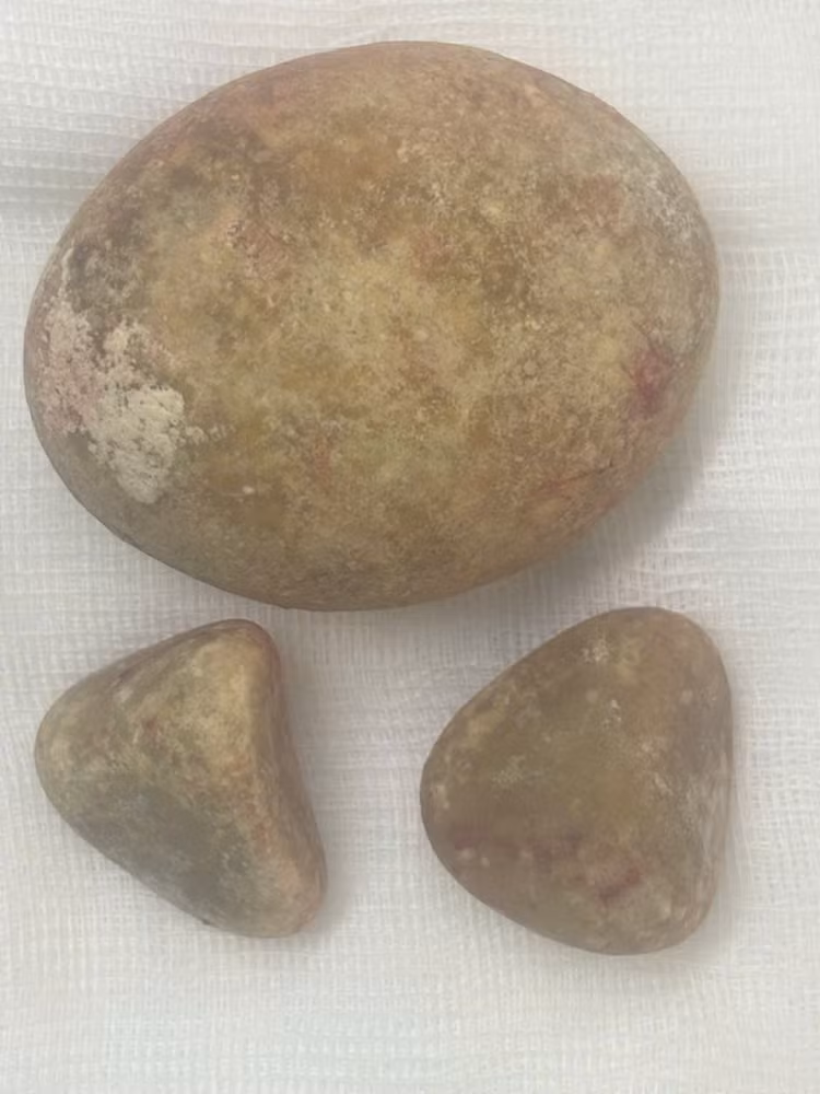 Viên sỏi trong bàng quang của ông D. Ảnh BVCC