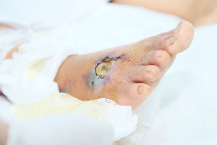 Vết thương hoại tử ở chân bệnh nhân. Ảnh BVCC