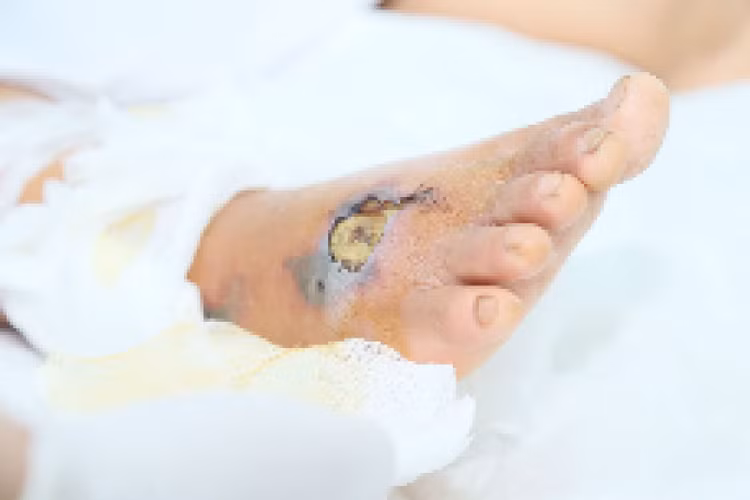 Vết thương hoại tử ở chân bệnh nhân. Ảnh BVCC