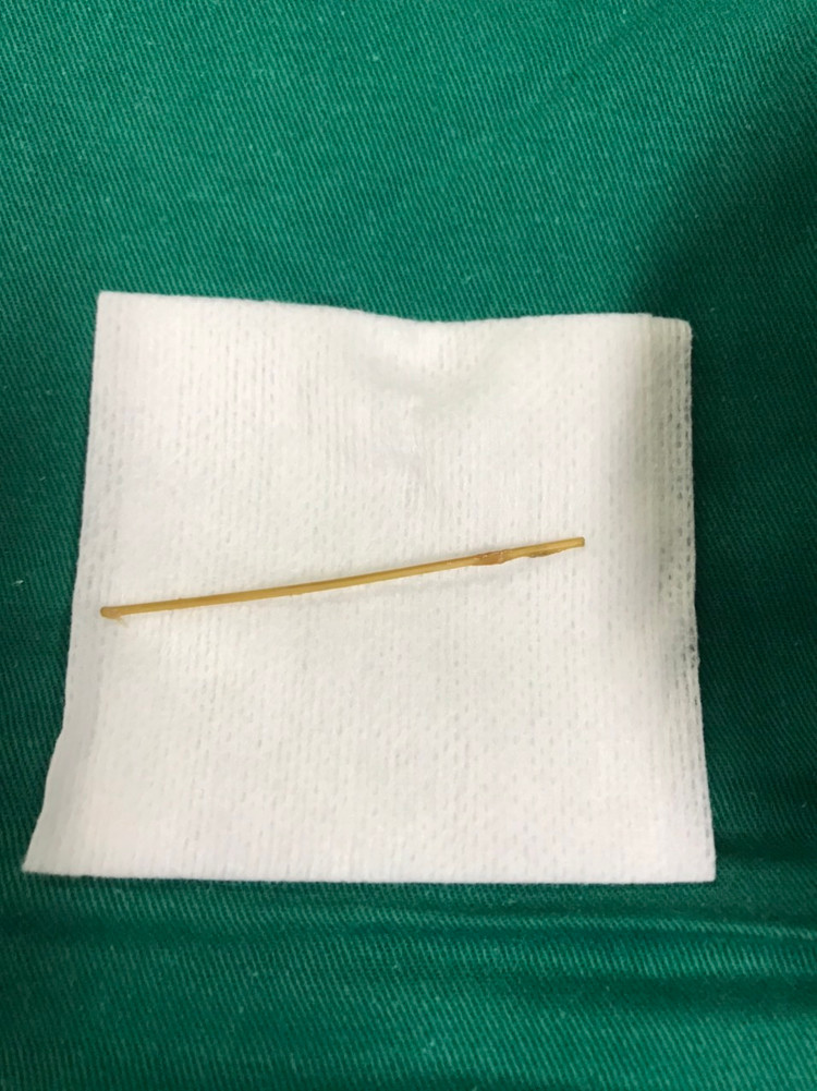 Dị vật được gắp ra từ ruột bệnh nhân. Ảnh BVCC