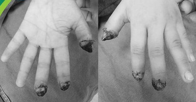 Tình trạng vết thương sau hơn 2 tuần điều trị của bệnh nhi. Ảnh BVCC