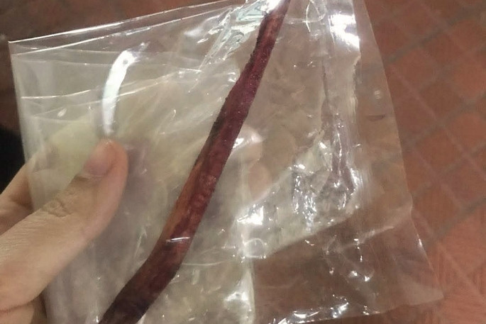 Dị vật mảnh gỗ được rút ra khỏi cổ của bệnh nhân. Ảnh BVCC