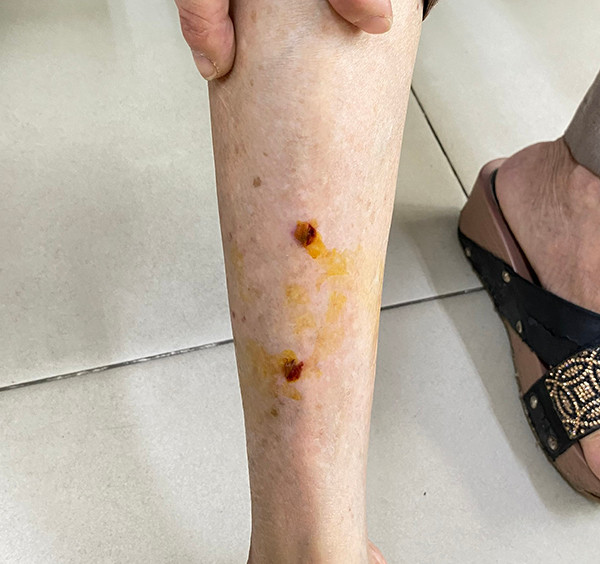 Vết thương ở chân của bệnh nhân do chó cắn. Ảnh CDC Đồng Nai