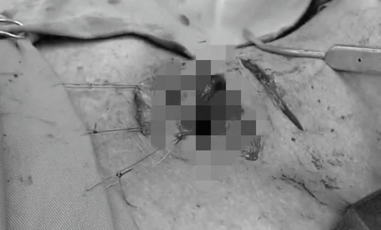 Dị vật đâm xuyên cổ và thủng động mạch cảnh của bệnh nhân. Ảnh BVCC