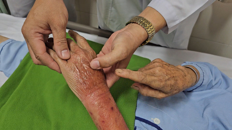 Bàn tay của bà M.T.L bị nhiễm trùng huyết sau khi bị kiến lửa cắn. Ảnh BVCC