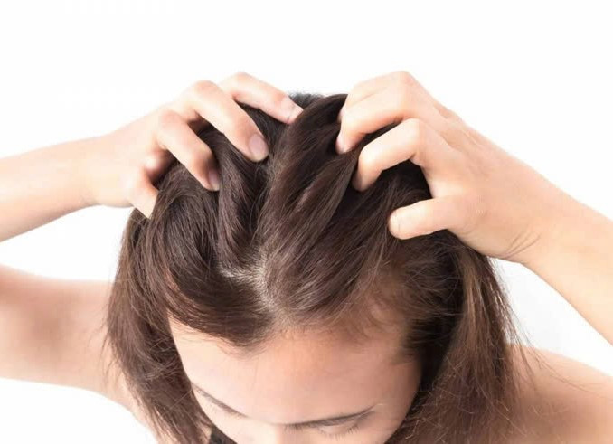 Mồ hôi, bụi bẩn có thể khiến cho da đầu hình thành nên rất nhiều tế bào chết. Ảnh: Internet