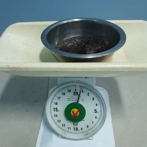 Dị vật búi tóc có cân nặng tới 700g. Ảnh SKĐS