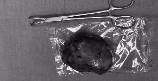 Khối bướu tuyến giáp có kích thước "khủng" được cắt bỏ trên người cụ bà 81 tuổi. Ảnh: Sk&amp;ĐS