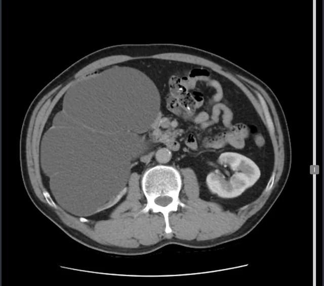 Thận phải của bệnh nhân ứ nước, kích thước 20x15cm, gần bằng quả bưởi kèm sỏi niệu quản. Ảnh Sk&amp;ĐS