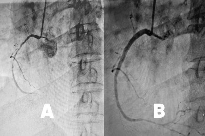 Động mạch vành phải hẹp nặng (hình A) và sau khi được nong mạch đặt stent (hình B). Ảnh BVCC