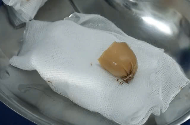 Dị vật là mẩu xúc xích được lấy ra khỏi thực quản bệnh nhi. Ảnh Trung tâm Y tế huyện Thanh Sơn