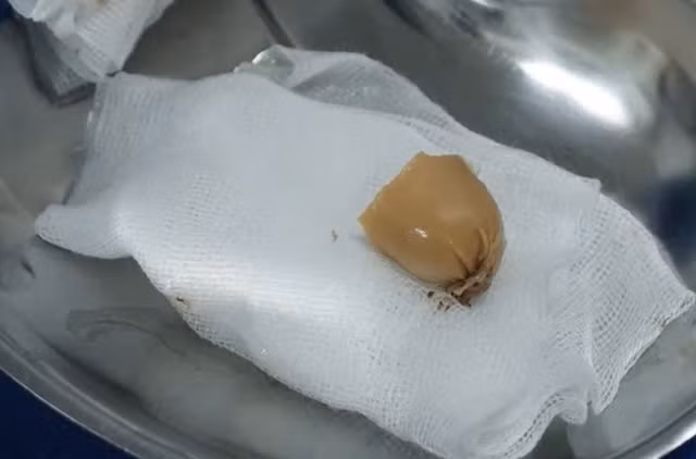 Dị vật là mẩu xúc xích được lấy ra khỏi thực quản bệnh nhi. Ảnh Trung tâm Y tế huyện Thanh Sơn