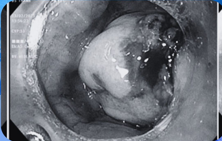 Hình ảnh chụp phát hiện khối ung thư tế bào vảy sừng. Ảnh BVCC