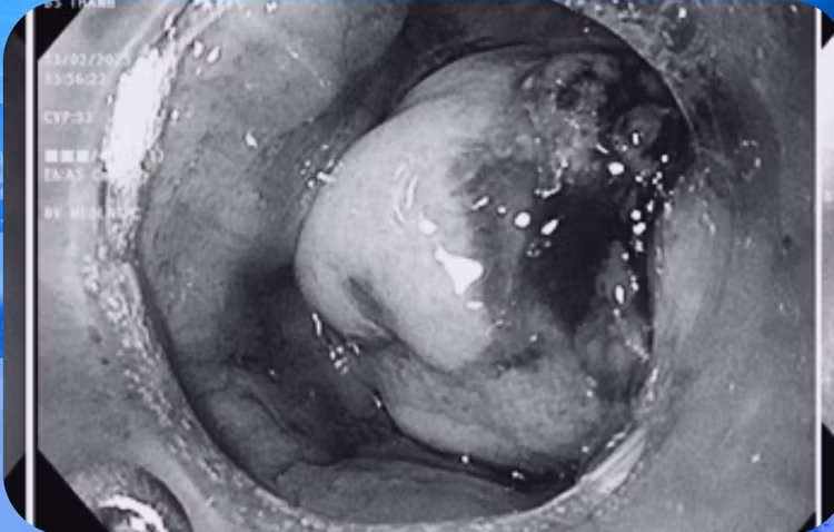 Hình ảnh chụp phát hiện khối ung thư tế bào vảy sừng. Ảnh BVCC