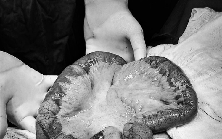 Người đàn ông 64 tuổi suýt hoại tử ruột non do thoát vị bẹn - Ảnh BVCC